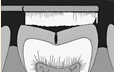 Dental Fissure1