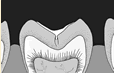 Dental Fissure 2