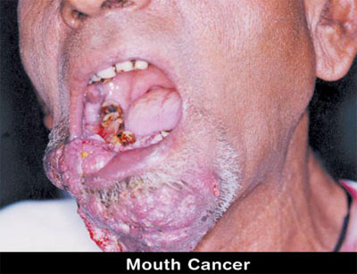 Chewing Tobacco