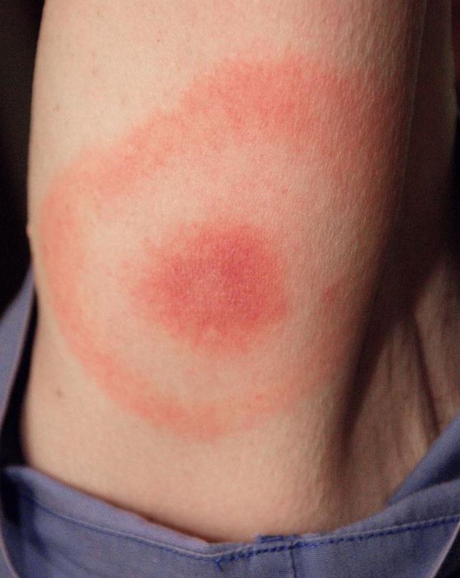 Bulls eye tick bite. A bulls eye tick bite. Photo by CDC/James Gathany