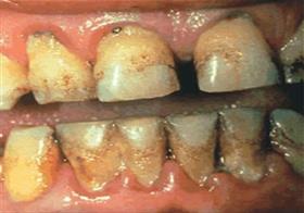Rotting teeth and gums